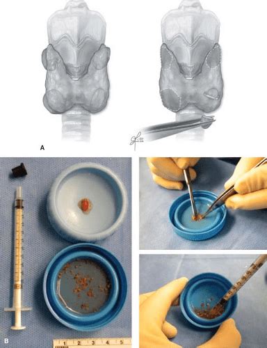 Comprehensive Parathyroidectomy For The Treatment Of Phpt