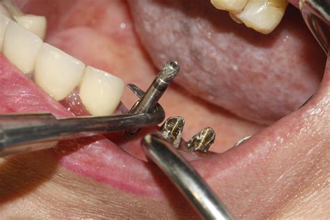 Dental Abutment
