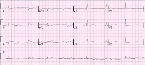 Many cardiac medications such as beta blockers, calcium channel blockers, and antiarrhythmics can cause heart block in high doses. Dr. Smith's ECG Blog: Intermittent third degree heart ...