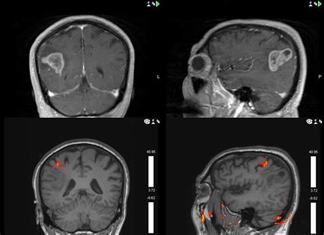 Cureus The Use Of 5 Ala In Glioblastoma Resection Two Cases With
