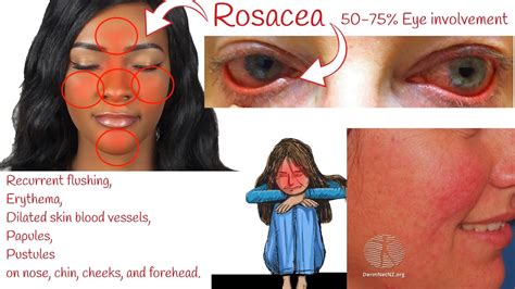 Rosacea Red Bumpy Face Skin Rosacea Symptoms And Treatment Youtube