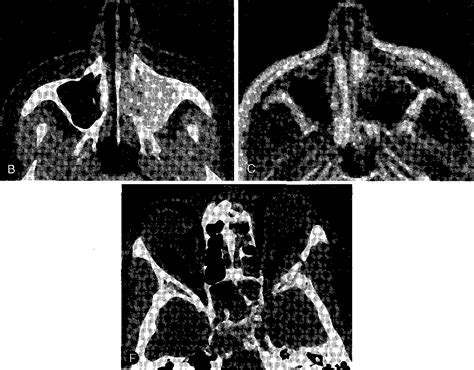 Figure 10 From Head And Neck Lesions Radiologic Pathologic