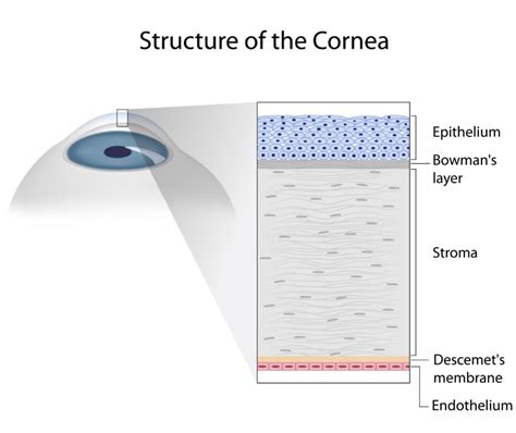 What Is The Cornea Ophthalmic Consultants Of Vermont