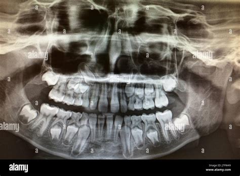 Panoramic Dental X Ray Of Childs Teeth Development Stock Photo