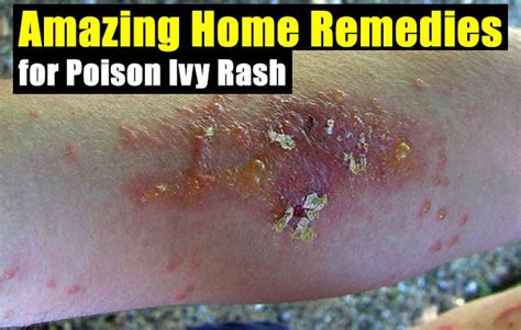 Amazing Home Remedies For Poison Ivy Rash Shtf Prepping