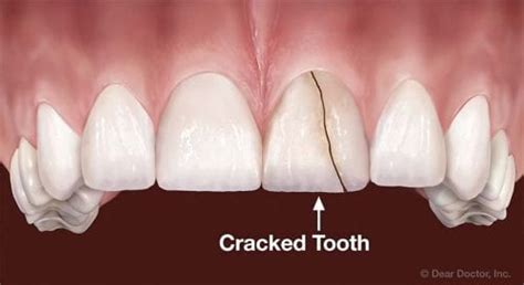 What Should You Do If You Have A Cracked Tooth Center For