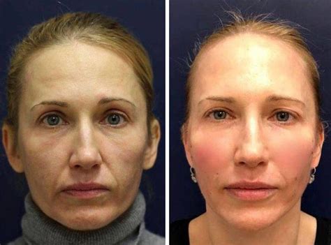 One Stitch Facelift Before And After Photos 19 Facelift Info