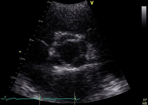 Echocardiogram Before Surgery Showing The Open Quadricuspid Aortic