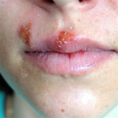Icd 10 Code For Lip Swelling Due To Allergic Reaction
