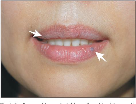 Figure 1 From Venous Lakes Of The Lips Successfully Treated By A Single
