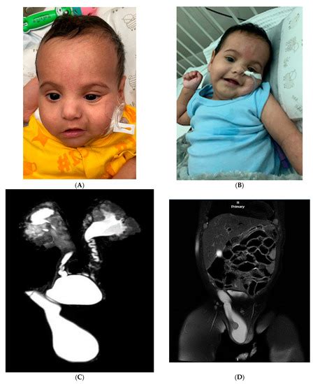 Genes Free Full Text Interstitial Deletion Of 3q21 In A Kuwaiti