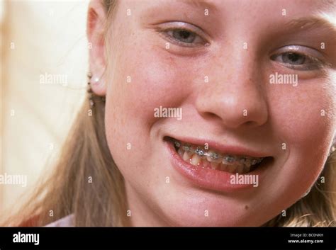 Portrait Teen Girl With Braces Stock Photo Alamy