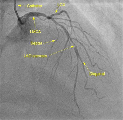 Diagonal branches of the left anterior descending artery. Angiography - All About Heart and Blood Vessels