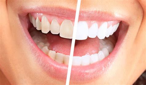 Teeth whitening with braces is one of the main concerns of people wearing braces and carring about how beautiful their smile is. Do I Need To Whiten My Teeth?