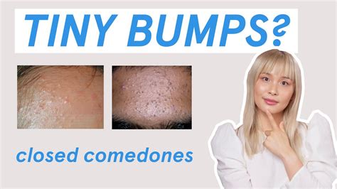 Why Those Tiny Bumps Arent Fungal Acne Youtube