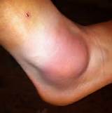 Pictures of Do You Put Heat Or Ice On A Sprained Ankle