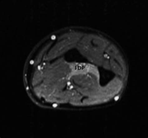 Kiloh Nevin Syndrome Anterior Interosseous Nerve Syndrome Image