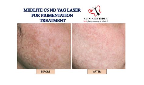 Laser Depigmentation Medlite C6 Skin Rejuvenation Skin Treatment