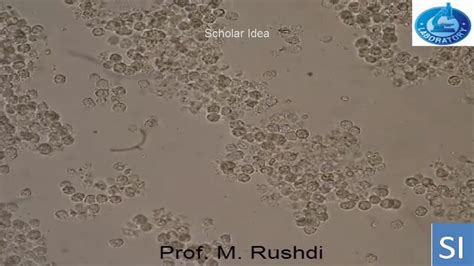 The term for this symptom is pyuria. Pus Cells In Urine Test Normal Range Hpf