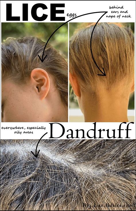 Lice Vs Dry Scalp Learn The 7 Key Differences Between Lice Eggs And Dandruff Lice Eggs Dry