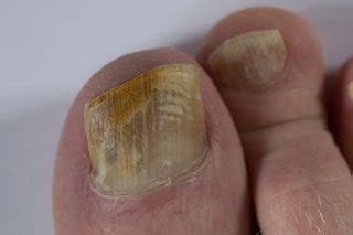 Nail Fungal Infection Archives Dr Physiotherapy Podiatry