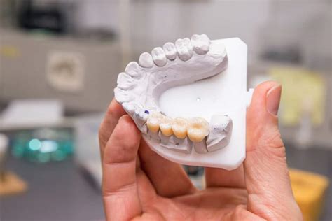 What To Expect During The Dental Bridge Procedure