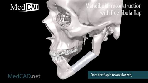 Mandibular Recon With Free Fibula Flap Single Piece Youtube