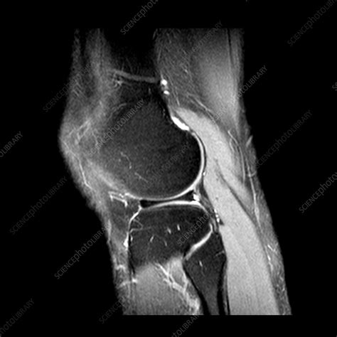 Normal Lateral Meniscus Mri Stock Image C0034574 Science