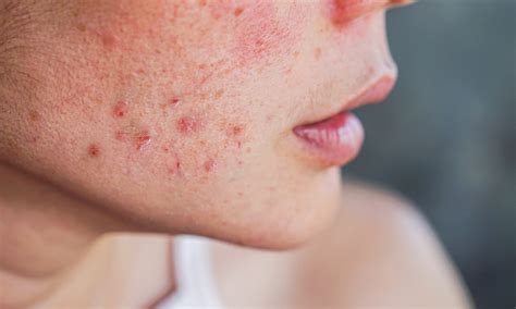 The Ins And Outs Of Acne Rosacea Rosalique Uk