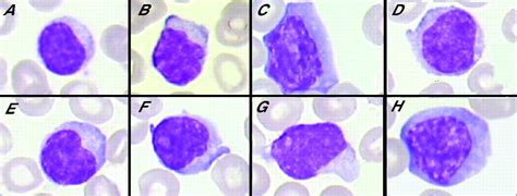 The Divergent Morphological Classification Of Variant Lymphocytes In