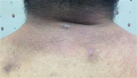 Derm Dx Itchy Rash On Eyelids Chest Back And Hands Clinical Advisor