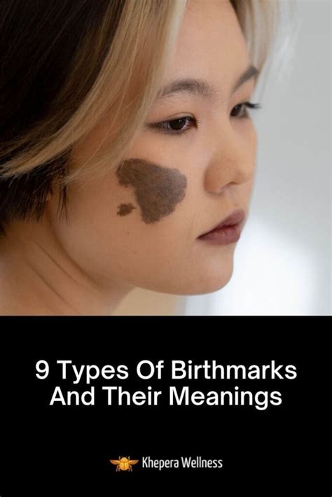 9 Types Of Birthmarks And Their Meanings Khepera Wellness
