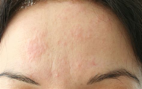 Forehead Rashes In Adults