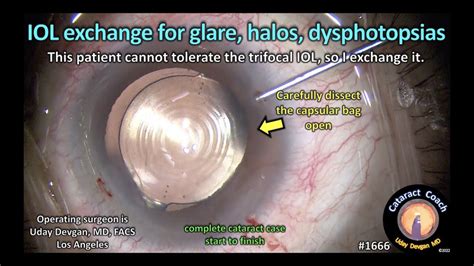 Halos Around Bright Lights After Cataract Surgery Shelly Lighting
