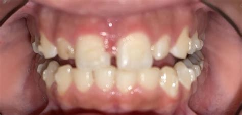 Gum Flap Over Wisdom Tooth Rdentistry