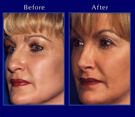 The Nose Clinic Before And After Nose Surgery Photos 14