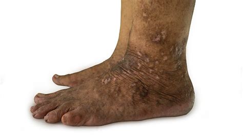 Psoriasis Feet