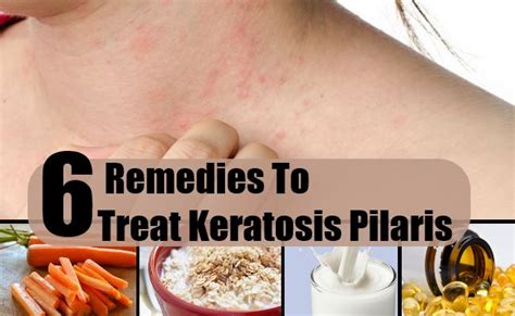 6 Natural Remedies To Treat Keratosis Pilaris Best Ways To Cure