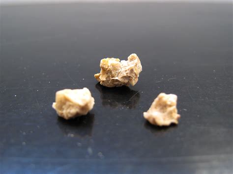 Pictures Of Different Types Of Kidney Stones