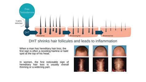 Share 89 Testosterone Causes Hair Loss Latest Ineteachers