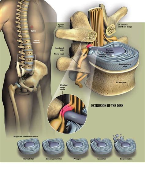 Chiropractic Care And Back Pain Non Invasive Treatment For Bulging