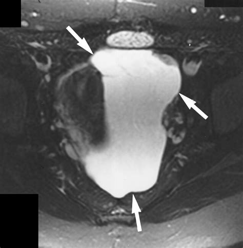 Imaging Of Peritoneal Inclusion Cysts Ajr