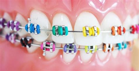 How To Choose The Color Of Your Braces Nevada Dentistry And Braces