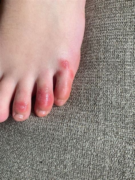 Covid toes are among the more commonly reported dermatologic manifestations. 'COVID Toes' May Be A New Symptom Of Coronavirus In Kids, Doctors Say | HuffPost Canada Parents
