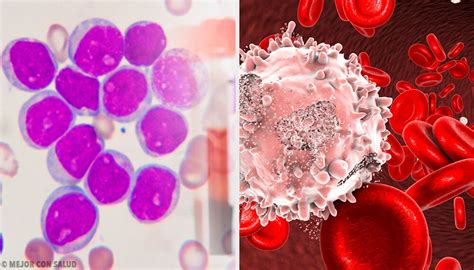 Leucemia mieloide crónica en transformación blástica. Leucemia mieloide crónica — Mejor con Salud