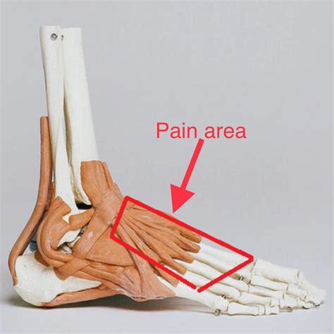 Sports Physiotherapist On Twitter EXTENSOR TENDONITIS TENDINOPATHY Extensor Tendonitis Is