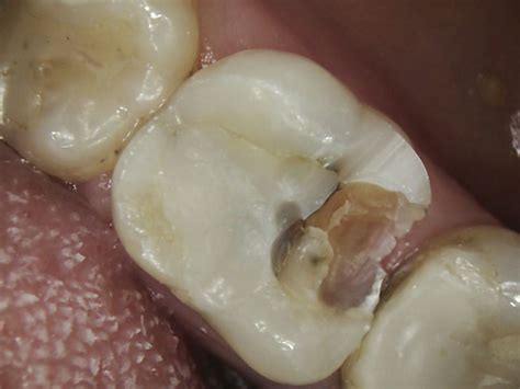 Broken Tooth Fillings And Crowns Bytes Dental Lismore