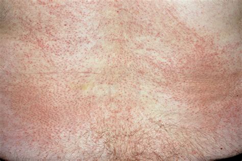 Cholinergic Urticaria Stock Image C0263304 Science Photo Library