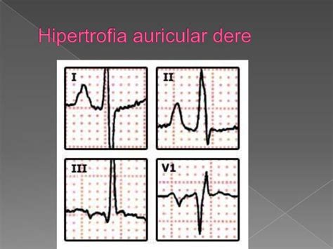 Ekg Hipertrofia Ventricular Y Auricular Derecha E Izquierda