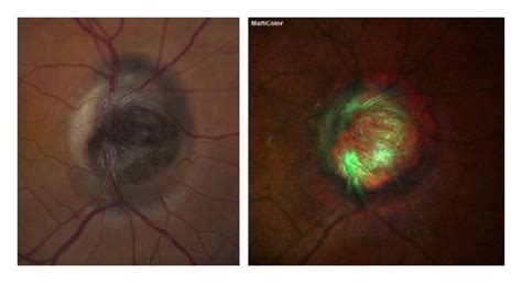 Optic Disk Photograph And Multicolor Showing A Deeply Pigmented Lesion